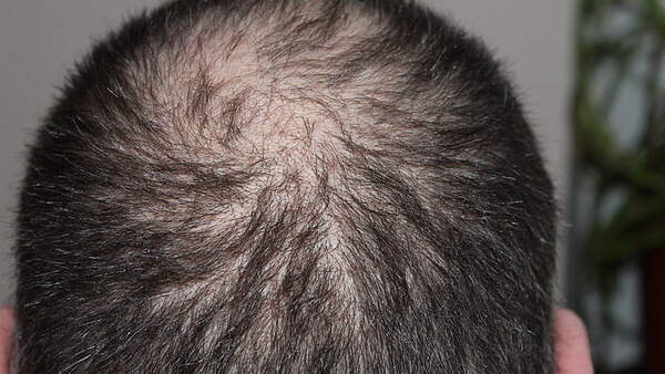 中老年人头顶头发稀少怎样植发？